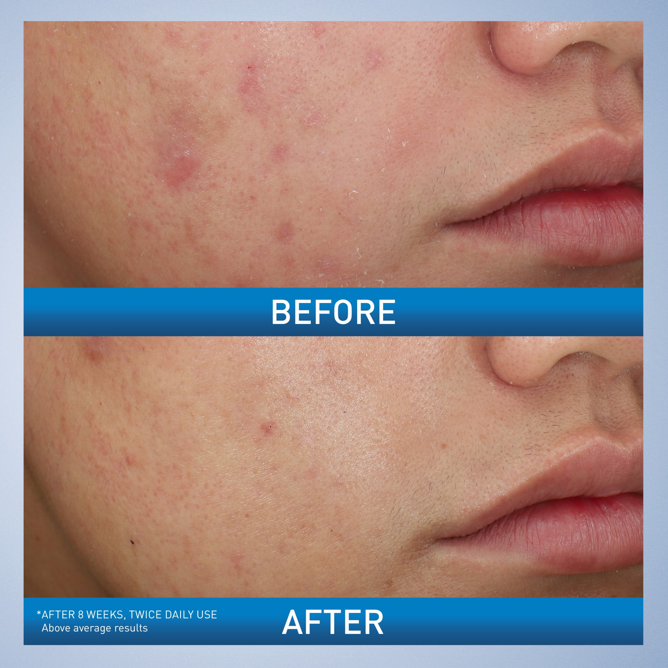 CeraVe Acne Foaming Cream Face Wash, 10% Benzoyl Peroxide Treatment, 5 fl oz