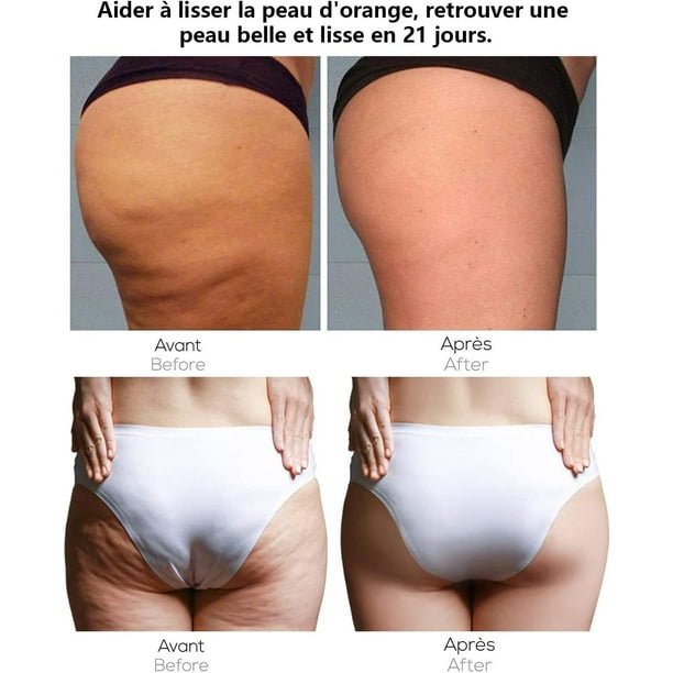 Ventosa anticelulitica 5 uds. Ventosa para celulitis rodillo adelgazante ventosas de masaje de silicona antienvejecimiento reductor de arrugas alivio del dolor reduce la tension muscular TUNC Sencille...