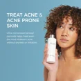 thumbnail image 5 of Jan Marini Skin Research Benzoyl Peroxide 2.5% Acne Treatment Wash - 8 Fl Oz, 5 of 8