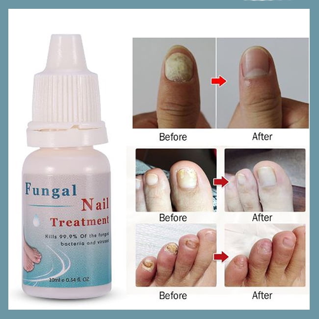 Bright Nail Repair Toenail Fungus Treatment 10 Ml Walmart Canada