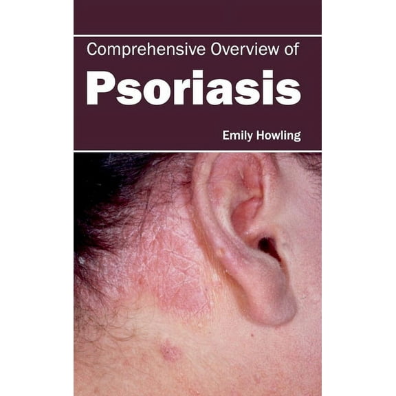 Comprehensive Overview of Psoriasis, (Hardcover)