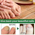 thumbnail image 4 of 1-3X 2024 New Essential Oil Nail Fungus Repair Liquid Nail Thickening Discoloration Off Soft Nail Thickening Type Onychomyc 20ml, 4 of 5