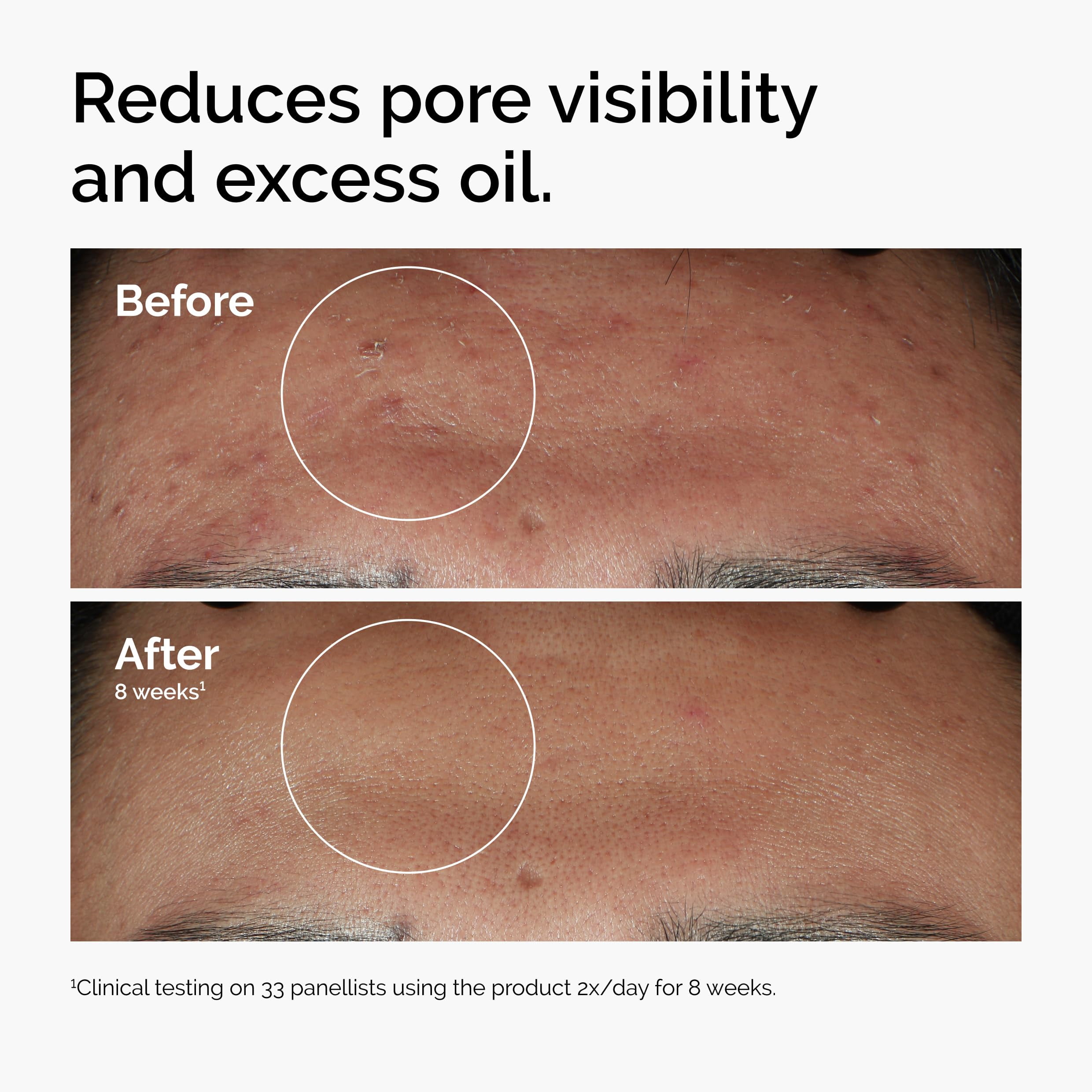 The Ordaniry Niacinamide 10% + Zinc 1%, Smoothing Serum for Blemish-Prone Skin 30mL