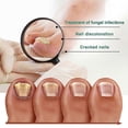 thumbnail image 2 of Fungal Nail Treatment, Extra Strong Nail Fungus Treatment for Toenail, Nail Repair -30ml, 2 of 5