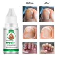 thumbnail image 1 of Professional Nails Repair Essence Nail Renewal Liquid Nail Fungus Treatments, 1 of 5