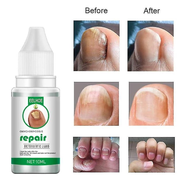Professional Nails Repair Essence Nail Renewal Liquid Nail Fungus Treatments