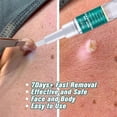thumbnail image 2 of Crema De Tratamiento Para Eliminar Verrugas Y Lunares, 5 Ml, Para El Cuidado Facial, Bolígrafo Natural Para Eliminar Verrugas Y Lunares, 2 of 4