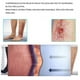 thumbnail image 5 of Medias De Compresión Elástica Médica De Adelgazamiento Medias De Venas Varicosas, 5 of 7