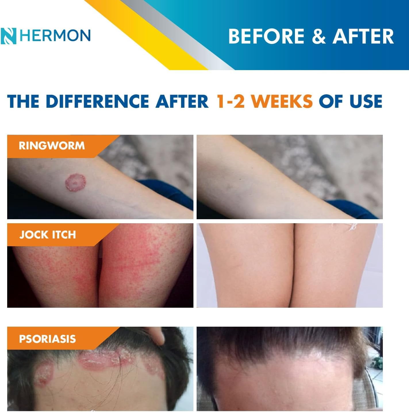 Hermon Powerful Antifungal Ringworm Cream - Treatment for Ringworm, Jock Itch, Eczema, Tinea Versicolor, Athlete's Foot  - 100ml