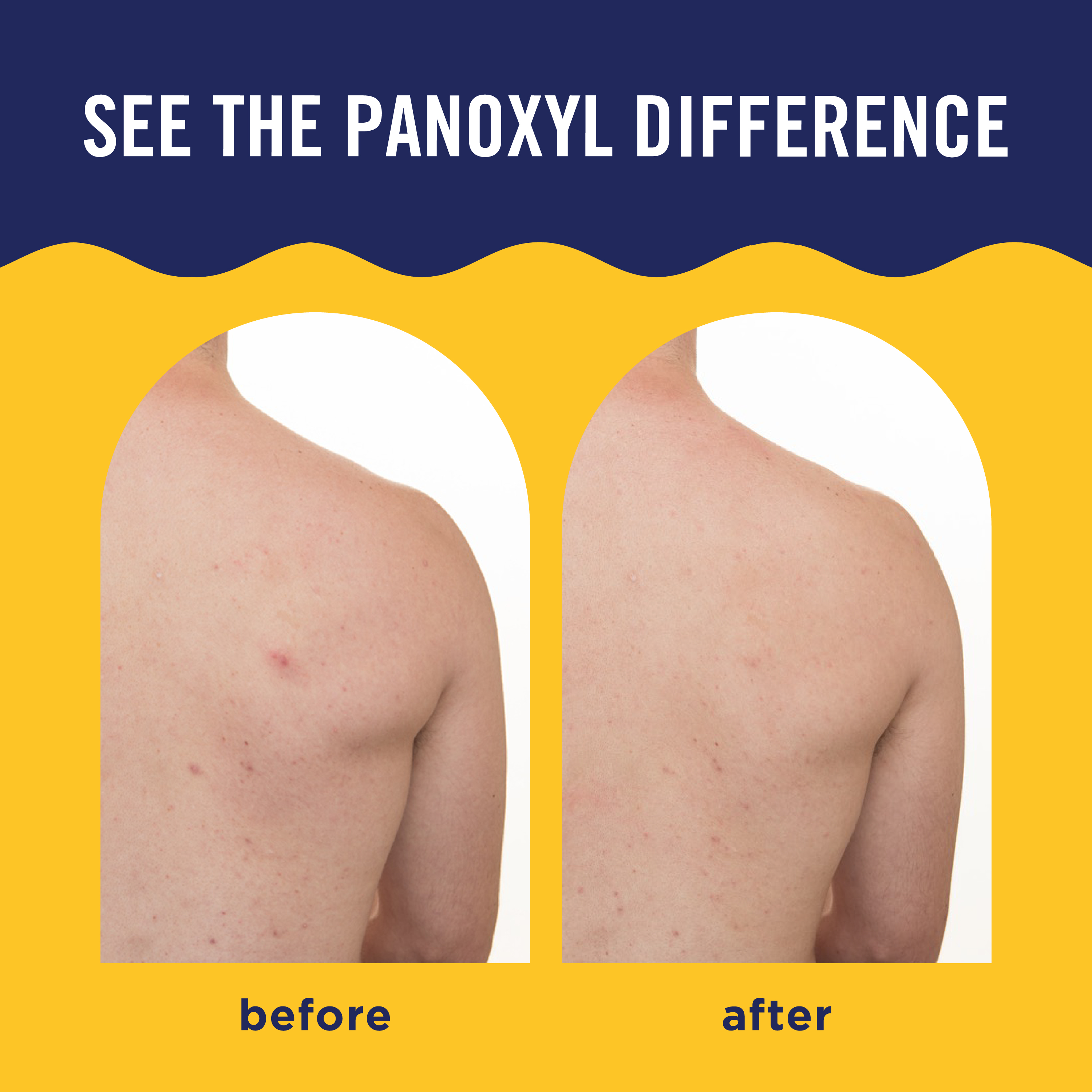 PanOxyl Acne Banishing Body Spray, 2% Salicylic Acid, 6 oz photo 6