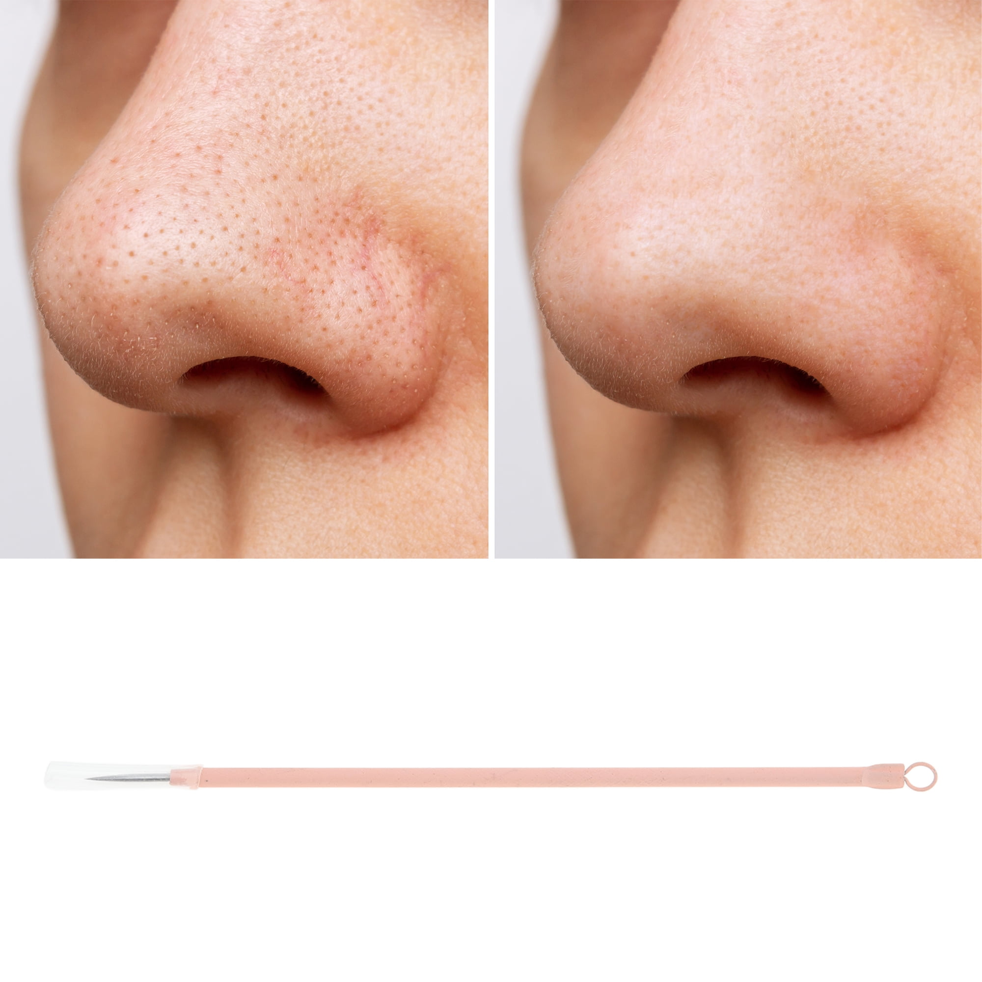 Unique Bargains 1pc Durable Squeeze Pimple Extractor Tool for Clear Skin Pink