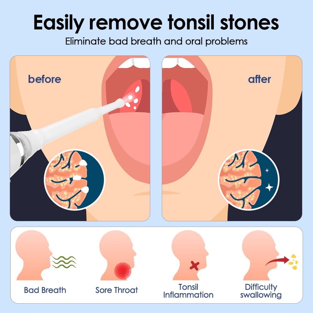 Tonsil Stone Remover, 3 Modes Adjustable Tonsil Stone Vacuum with LED Light Tonsil Stone Water Flosser for Men Women