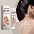 thumbnail image 3 of Vitiligo Relief Cream, Natural Cream For Vitiligo Treatments, Portable Anti-itch Body Care Cream Skin Care Products, 3 of 5