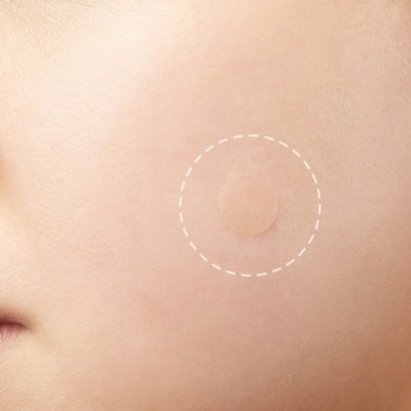 USYFAKGH Acne Pimple Master Patch 24 patches Pimple Treatment