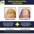 Nonyx Nail Gel Before And After Nonyx Fungal Nail Clarifying Gel - Rids Toenails of Fungus by Removing