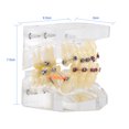 thumbnail image 2 of Tratamiento de Ortodoncia Dental de Maloclusión de Dientes Modelo con Cadena de Alambre Estudio Amonsee NO, 2 of 6