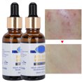 thumbnail image 4 of Suero Para Eliminar espinillas ANGGREK Extracto de Planta 2 Botellas de Tratamiento Para El Acne, 4 of 8