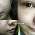 thumbnail image 3 of Solución de ácido salicílico al 2% de 30ml, elimina el suero facial para el acné, reduce la esencia hidratante de los poros, ilumina el cuidado de la piel del rostro kaili Sencillez, 3 of 4