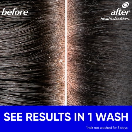 Head and Shoulders Dandruff Shampoo, Classic Clean, Light Fresh Scent, 8.45 fl oz