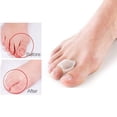 thumbnail image 1 of Alisador de dedo gordo del pie, Protector de valgo para pulgar, Gel de silicona, separador de dedos de los pies, ajustador de juanetes, almohadillas para los pies, alivio del dolor en los pies Tan Jianjun unisex, 1 of 2