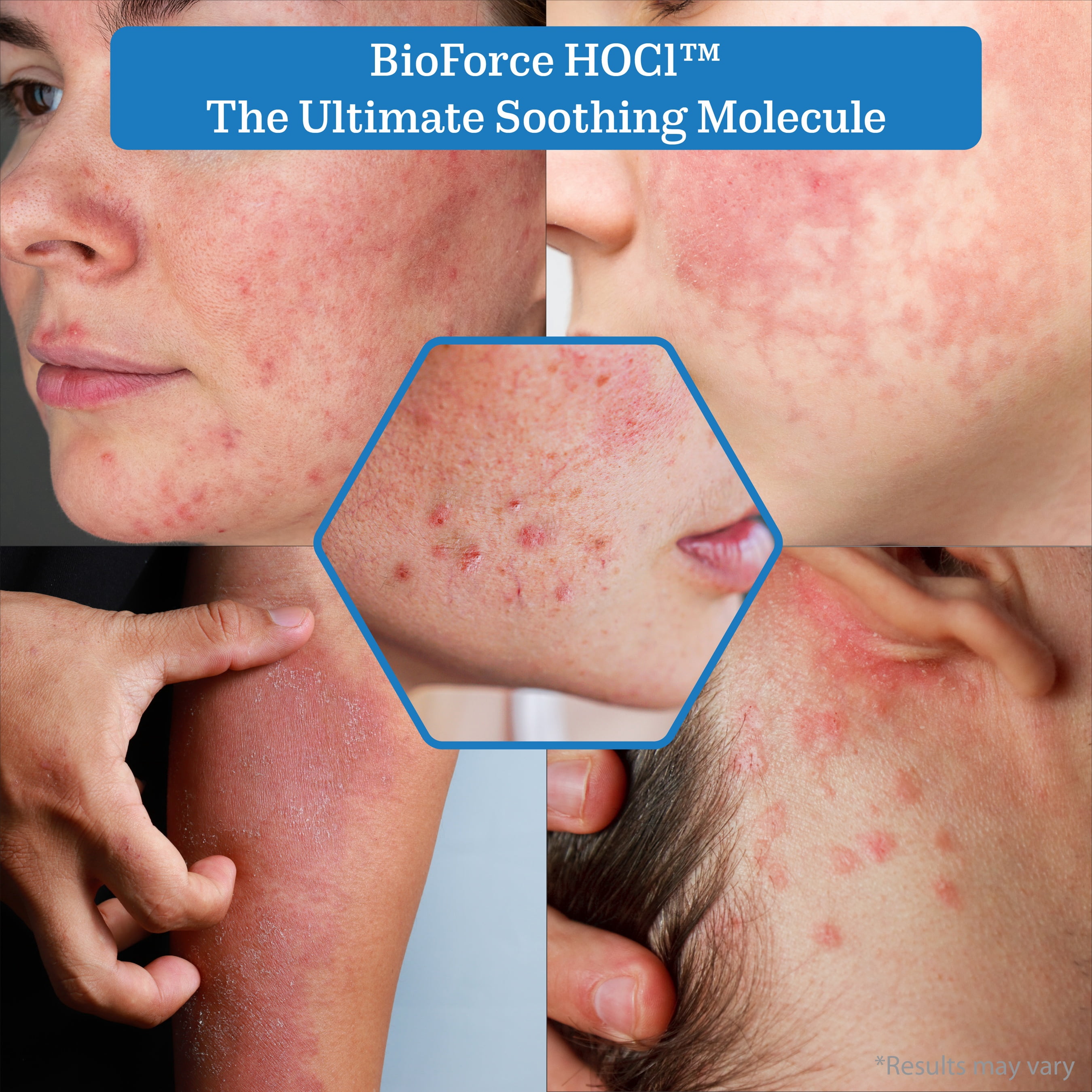 BioForce HOCl Hypochlorous Acid Spray Refill 33 oz – Face & Body, Acne & Eczema Care, pH-Balanced