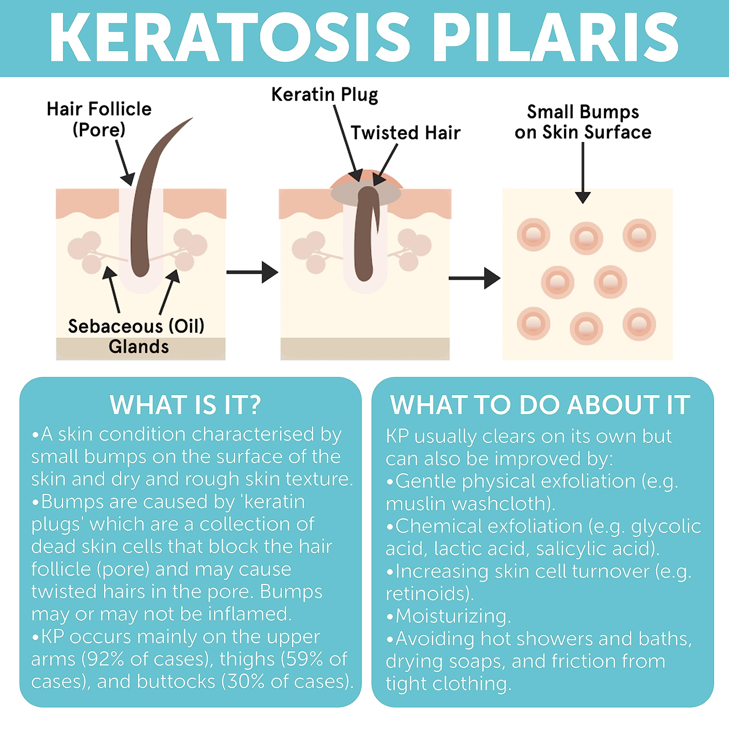 KP Bump Eraser Lotion Keratosis Pilaris Lotion with Glycolic Acid, AHA & BHA Exfoliating Rough & Bumpy Skin Body Lotion