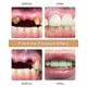 thumbnail image 4 of 2024 Nwe Diy Denture Kit, Denture Diy Kit Is Simple And Convenient Diy Denture Repair Missing, Sn (319), 4 of 5