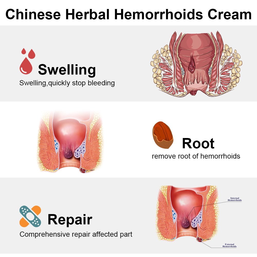 internal hemorrhoid swelling