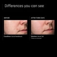 thumbnail image 4 of PCA SKIN Gel facial para tratamiento de manchas de acné, suero facial iluminador con ácido salicílico al 2% para exceso de aceite, brotes y manchas oscuras (1 fl oz), 4 of 8
