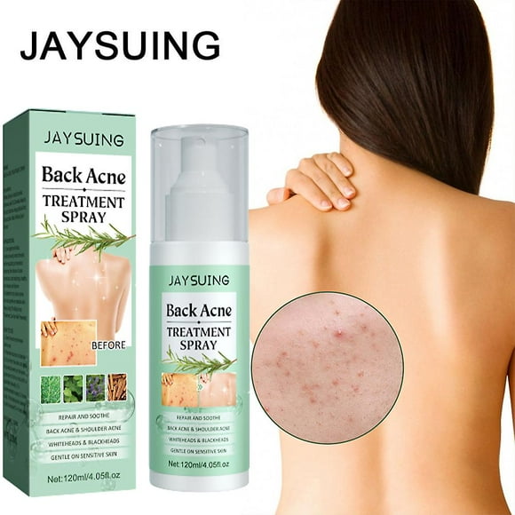 Back Acne Treatment Spray