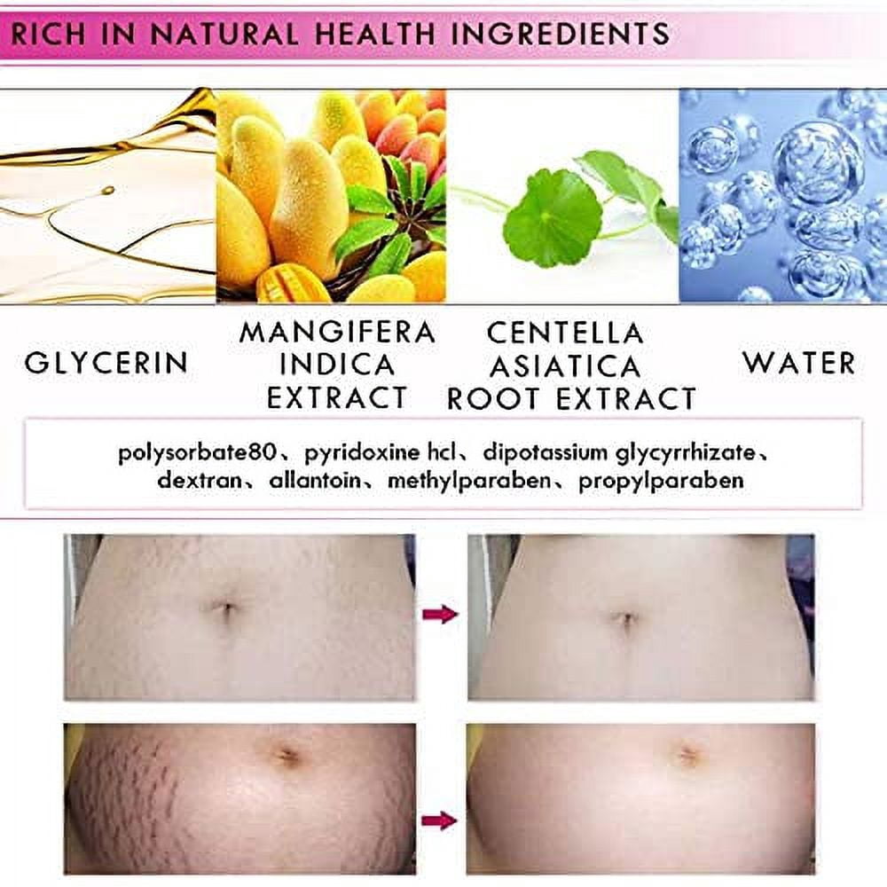 RtopR Mango Stretch Marks and Scar Cream -Stretch Marks and Scar Removal Cream for Pregnancy - Best Body Moisturizer-40g