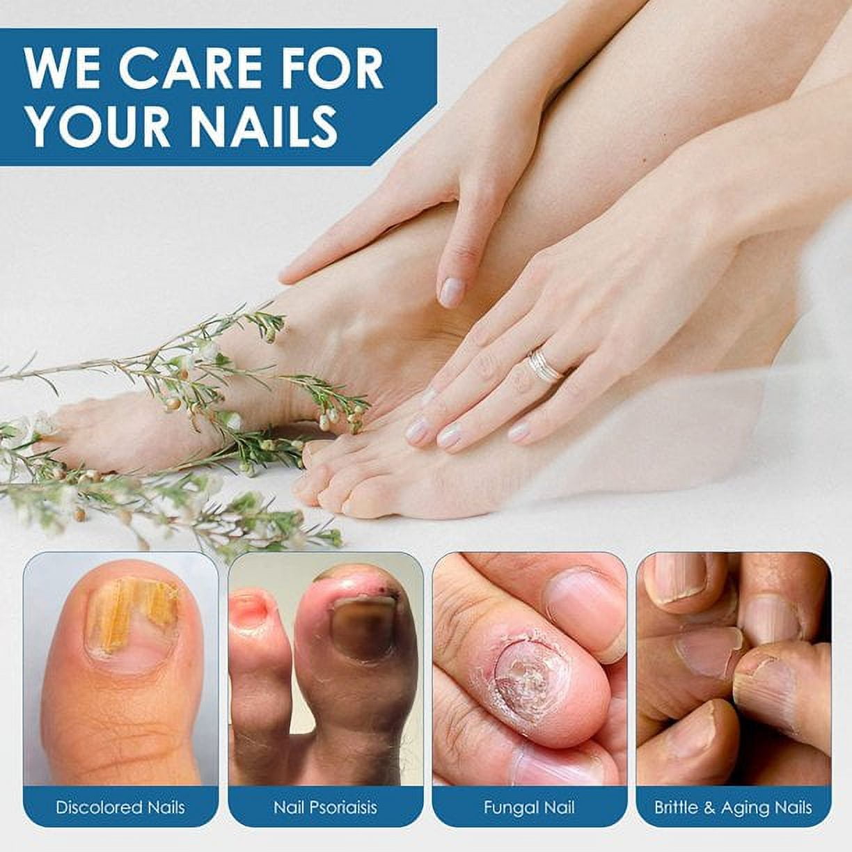 Is this toenail fungus? Find out here. – Eltham Foot Clinic
