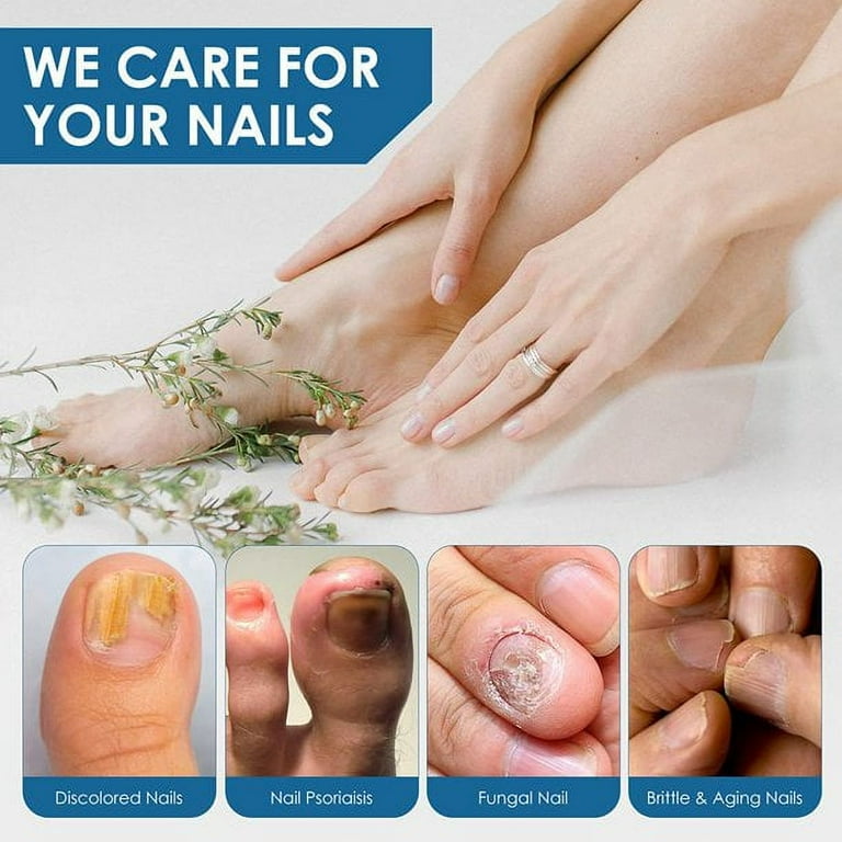 Toenail Fungus Treatment Nail Fungus Treatment for Toenail Fungus Nail Treatment for Discolored and Damaged Nails