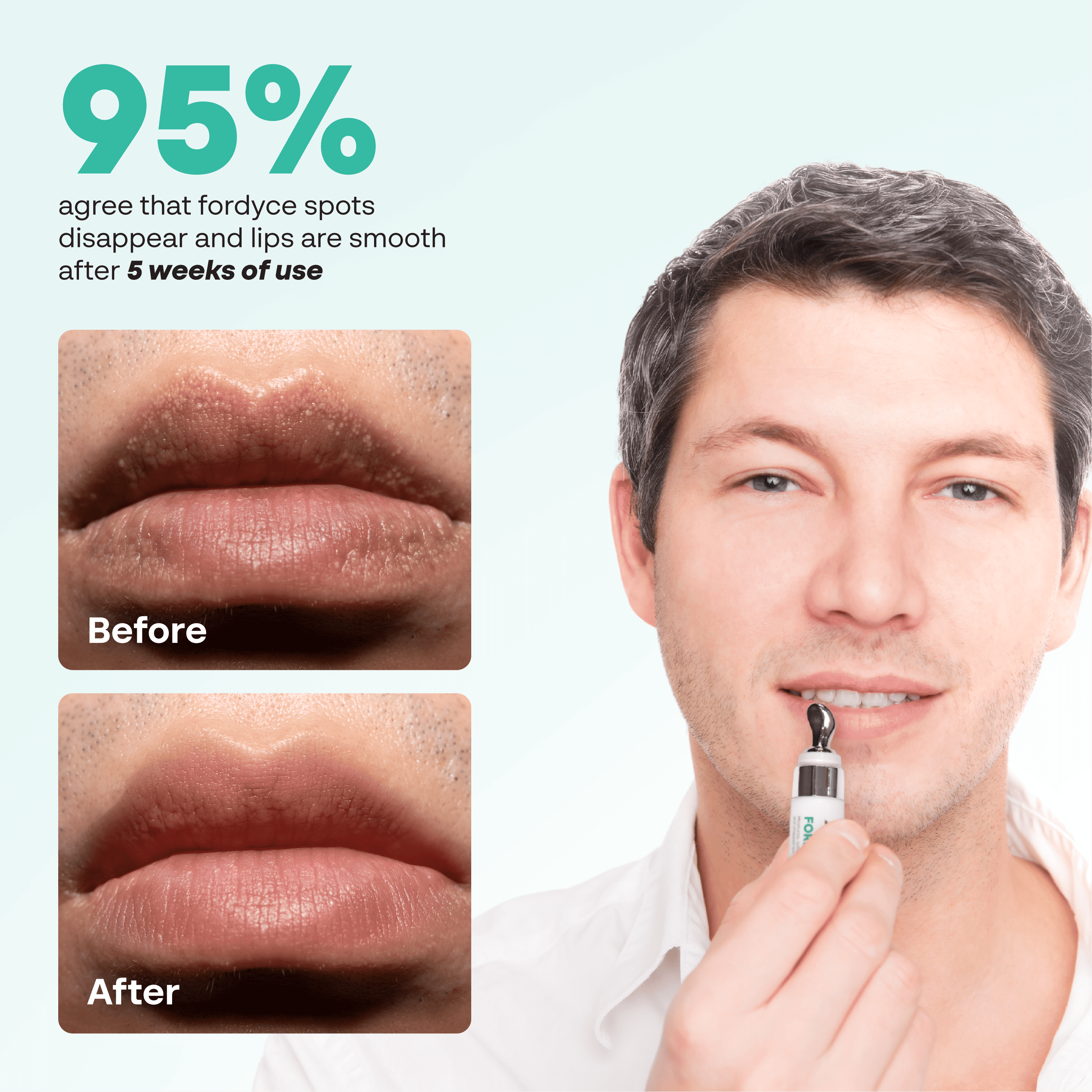 ABERA Fordyce Spot Lip Cream with HPR Retinoid, Moisturizing Repair For Dry Chapped Lips, 0.7 fl oz - Combo 2
