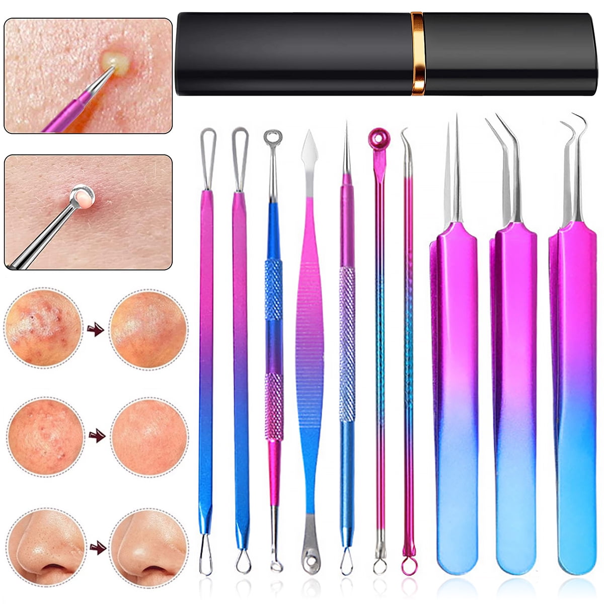 10pcs Blackhead Remover Tool Kit Stainless Steel Pimple Popper Tool Comedones Extractor