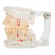 thumbnail image 1 of Modelo de dientes de enfermedad transparente, modelo de dientes de implante Dental, instrumentos de enseñanza para estudio hospitalario, 1 of 8