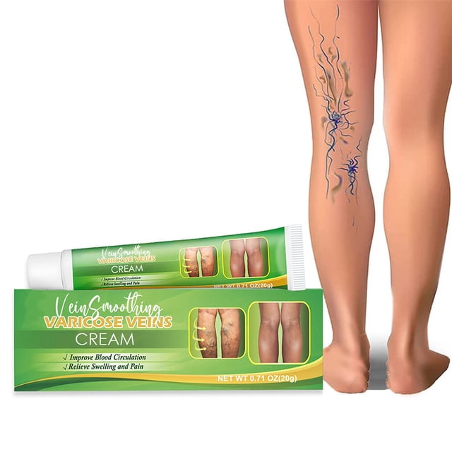 Crema eficaz para aliviar las varices, las arañas vasculares, la flebitis y la angiitis en las piernas, el cuerpo y los brazos