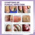 thumbnail image 5 of Medinail Fungus Spray - 3pcs Set, 5 of 5