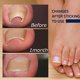 thumbnail image 4 of Parche corrector de uñas encarnadas 150PCS, 4 of 5