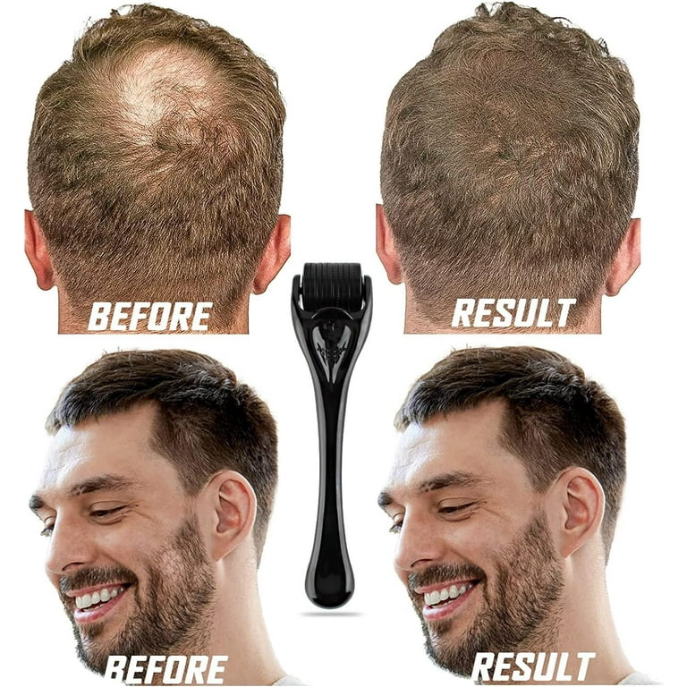 Derma Roller for Hair & Beard Growth - 540 Pins Titanium Microneedling Roller Beard Dermaroller for Face Body Scalp Men Women (0.3mm)