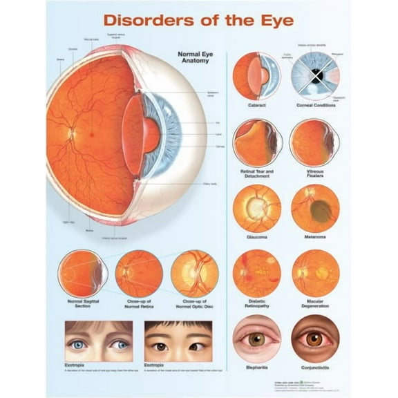 Disorders of the Eye Anatomical Chart