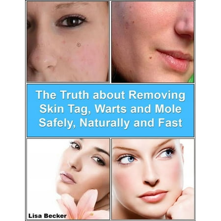 The Truth About Removing Skin Tag, Warts and Mole Safely, Naturally and Fast - (Best Way To Remove A Mole On Your Face)