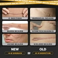 thumbnail image 3 of Skin Grip Medical Grade Silicone Scar Tape 1.6"x120" Roll –Increased Strength & Reduced Irritation – Silicone Scar Sheets for Face, Surgical Scars, C-Section, Keloid, Tummy Tuck, Burn - Skin, 3 of 7