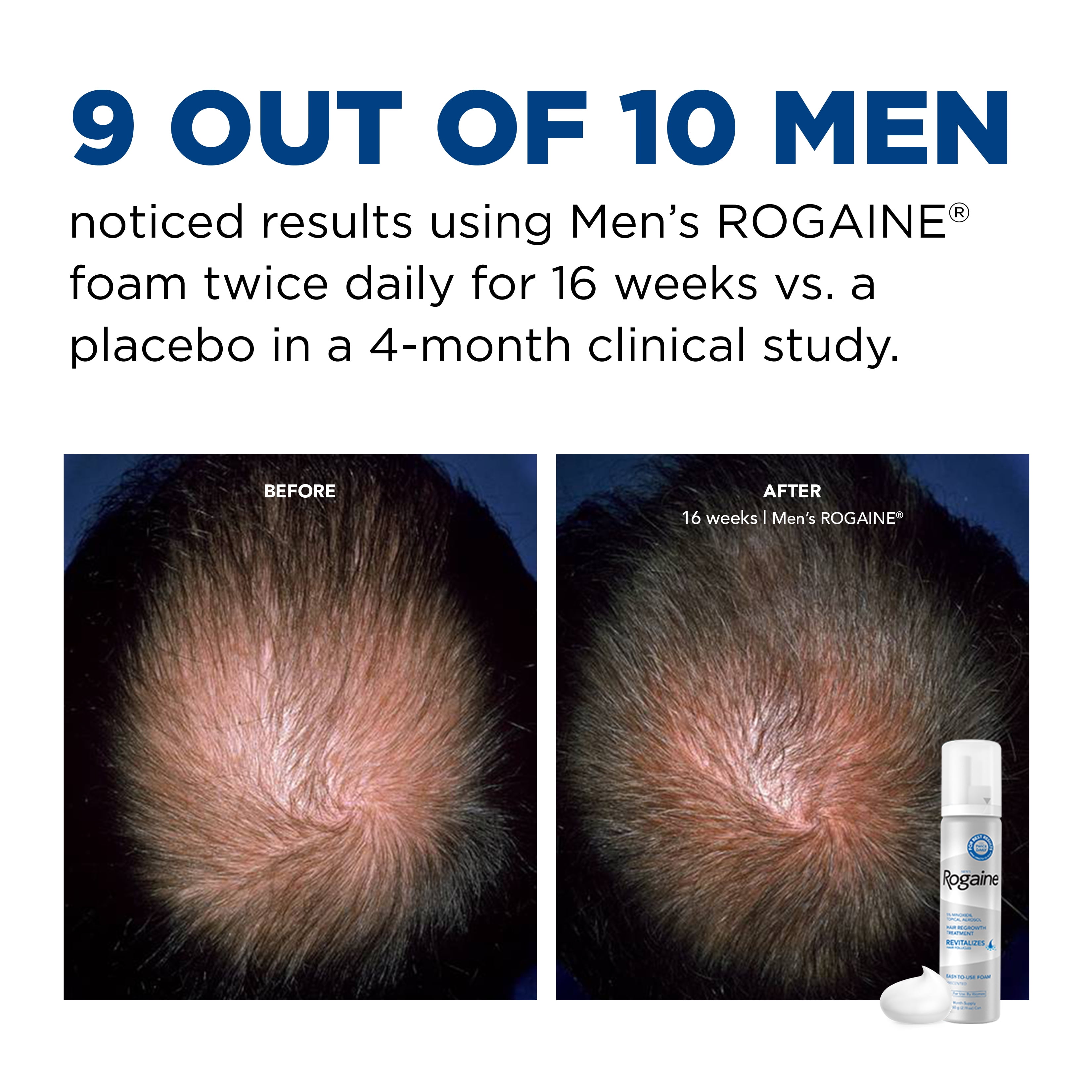 Men S Rogaine 5 Minoxidil Foam For Hair Regrowth 3 Month Supply