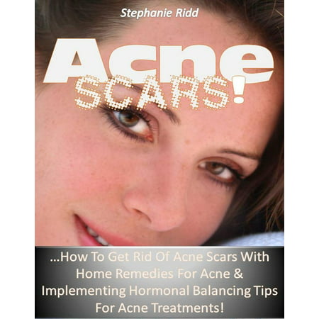Acne Scars! …How to Get Rid of Acne Scars with Home Remedies for Acne & Implementing Hormonal Balancing Tips for Acne Treatments! - (Best Cream To Get Rid Of Acne Scars)