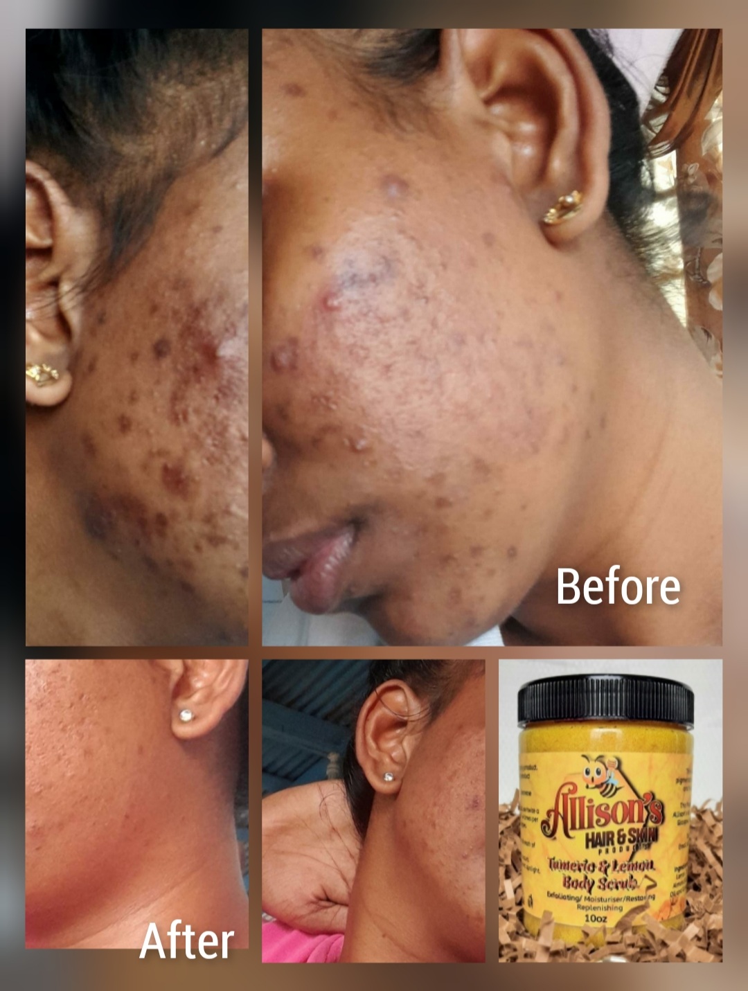 Noni Soap For acne breakouts Handmade and Farmed in Guyana