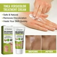 Tinea Versicolor Treatment Cream, Antifungal Cream for Tinea Versicolor & Pedis