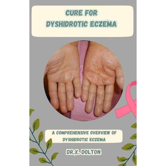 Cure for Dyshidrotic Eczema : A Comprehensive Overview of Dyshidrotic Eczema (Paperback)
