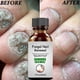 thumbnail image 3 of Nail Ingrown Repair Solution Anti-Infection Onychomycosis Paronychia Repair Serum for Broken Cracked Split and Weak Nails, 3 of 5