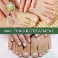 thumbnail image 2 of Extra Strong Nail Fungus Treatment, Best Nail Repair Stop Fungal Growth Effectiv, 2 of 5